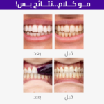 ⁦هاي سمايل لصقات تبييض أسنان V34 بربل - 14 لصقة⁩ - الصورة ⁦3⁩