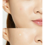 ⁦لصقات حب الشباب من كوسركس - 24 قطعة⁩ - الصورة ⁦2⁩