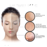 ⁦قناع الفحم للتنظيف العميق بفقاعات الاكسجين من بيو ديرم⁩ - الصورة ⁦4⁩