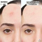 ⁦غارنييه لصقات غير المرئية لعلاج البثور - 22 لصقة⁩ - الصورة ⁦5⁩